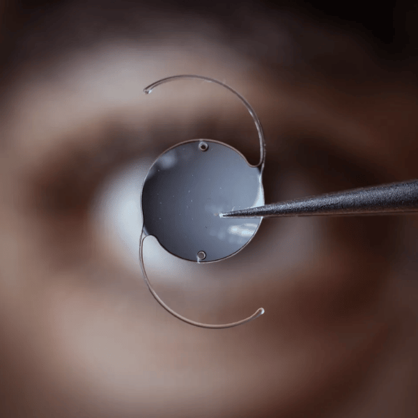 Close macro de lente intraocular sendo posicionada com pinça de microcirurgia sobre o olho humano, fundo desfocado em tons de marrom e âmbar, iluminação clínica dramática, fotografia macro ultra-realista de procedimento oftalmológico de catarata